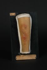 Gommes tuberculeuses de la jambe, ayant résisté au traitement antisyphilitique