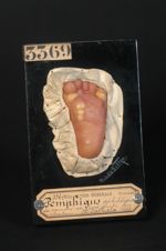 Pemphigus syphilitique des nouveau-nés