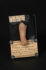 Fibro-myxome du doigt (Obs. par A. Sézary et Horowitz in Bull. de la soc. fr. de derm. et de syph.,  [...]