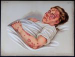 [Diagnostic non mentionné] - Atlas der Hautkrankheiten