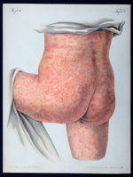 Urticaria rubra - Atlas der Hautkrankheiten