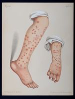 Urticaria papulosa. Lichen urticatus  - Atlas der Hautkrankheiten