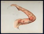 Pemphigus pruriginosus - Atlas der Hautkrankheiten
