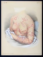 Psoriasis orbicularis - Atlas der Hautkrankheiten
