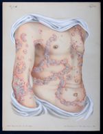 Psoriasis gyrata - Atlas der Hautkrankheiten