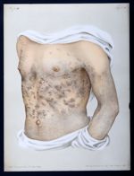 Icthyosis simplex - Atlas der Hautkrankheiten