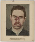 Hôpital Saint-Louis, service de M. le Docteur Besnier - Farcinose mutilante de la face (face) [recto [...]