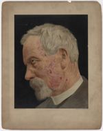 Observation de M. le Docteur Brocq [recto] - Lupus érythémateux chronique (profil gauche)