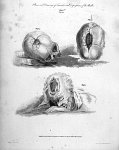 Plans and drawings of fractures and depressions of the skull - The principles of surgery