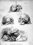 Plans and drawings of fractured skulls - The principles of surgery