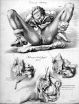Posture for lithotomy. Lithotomy with the gorget - The principles of surgery