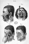 Résection du maxillaire inférieur et du maxillaire supérieur - Précis iconographique de médecine opé [...]
