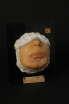 Syphilide tuberculeuse en nappe, forme sèche, du menton