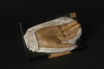 Syphilide palmaire psoriasiforme de la main droite