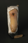 Gomme syphilitique gangreneuse de la jambe