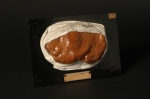 Lésions syphilitiques tertiaires du foie (reproduction d'une pièce anatomique)