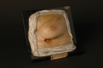 Gomme syphilitique ulcérée de la région sous-mammaire
