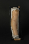 Syphilide tuberculeuse plate de la jambe