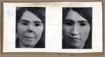 [Portraits d'une femme, de face, avant et après pose de prothèse nasale.]