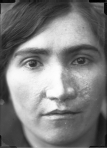 [Portrait d'une femme de face après pose de prothèse nasale.] 