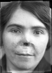 [Portrait d'une femme de face avant pose de prothèse nasale.]