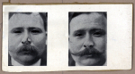 [Portraits d'un homme de face avant et après pose d'une prothèse nasale.]