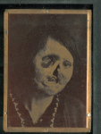 [Portrait de femme de trois quarts, mutilée de la face présentant une perte de substance du maxillai [...]