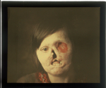[Portrait de femme de face, mutilée de la face présentant une perte de substance du maxillaire infér [...]