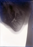 [Radiographie. Maxillaires supérieur et inférieur, de profil. Maxillaire supérieur appareillé.]