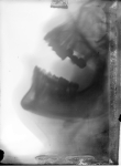 [Radiographie. Maxillaires supérieur et inférieur, de profil, bouche ouverte.]