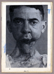 [08a: Portrait d'homme de face présentant une perte du maxillaire inférieur, une plaie du cou et du  [...]