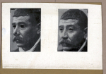 [Portraits d'un homme de trois quarts à gauche, avant et après pose de prothèse nasale.] 