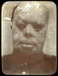 [Plaque photographique de projection. Portrait de face sans prothèse faciale montrant des cicatrices [...]