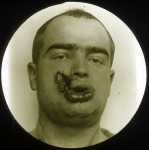 [Plaque photographique de projection. Portrait de face préopératoire montrant un œdème de la lèvre i [...]