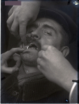 [Portrait de trois quarts avec vue sur la dentition du patient, porteur d'un appareillage.]