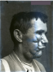 [Portrait de profil montrant une importante cicatrice de l'aile du nez à la commissure labiale, avec [...]