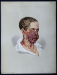 Lupus serpiginosus hypertrophicus - Atlas der Hautkrankheiten