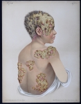 Favus - Atlas der Hautkrankheiten