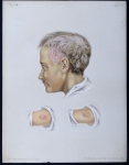 Herpes tonsurans et favus - Atlas der Hautkrankheiten