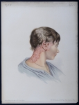 Eczema squamosum seu pityriasis rubra - Atlas der Hautkrankheiten