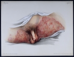 Eczema marginatum - Atlas der Hautkrankheiten