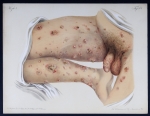 Scabies - Atlas der Hautkrankheiten