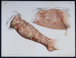 Fig. 1  : Eczema rubrum artificiale / Fig.  2 : Eczema impetiginosum in pruriginoso - Atlas der Haut [...]