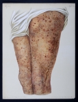 Prurigo agria seu ferox mihi - Atlas der Hautkrankheiten
