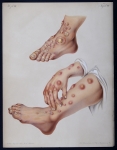 Erythema nodosum - Atlas der Hautkrankheiten