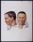 Fig .1  et 2 : Herpes facialis seu zoster faciei duplex - Atlas der Hautkrankheiten
