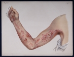 Herpes zoster brachiale - Atlas der Hautkrankheiten