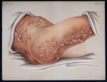  Fig .1  : Herpes zoster abdominalis / Fig. 2 : Herpes zoster femoralis - Atlas der Hautkrankheiten