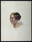 Argyria Teinte bronzée - Atlas der Hautkrankheiten