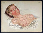 Roseola cholerica - Atlas der Hautkrankheiten